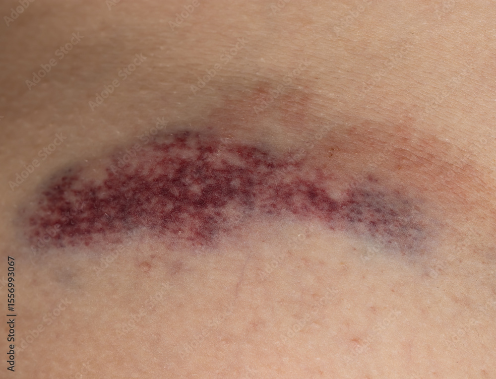 Fototapeta premium A bruise on a person's arm