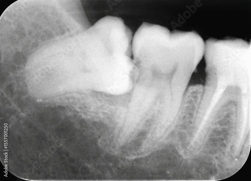 Periapical x-ray showing malposition of right lower wisdom tooth and caries on a second mandibular molar.
