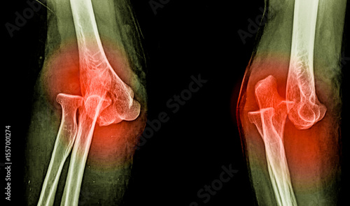 An x-ray image of elbow dislocation 