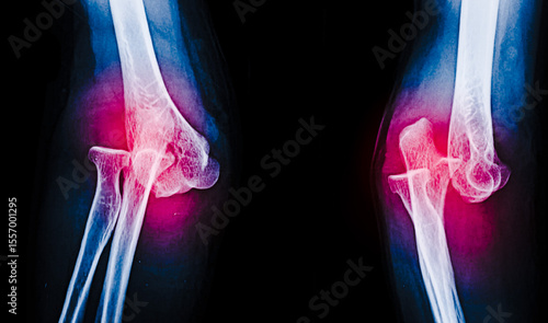 Εκτύπωση καμβά An x-ray image of elbow dislocation