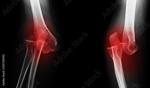 Photos An x-ray image of elbow dislocation