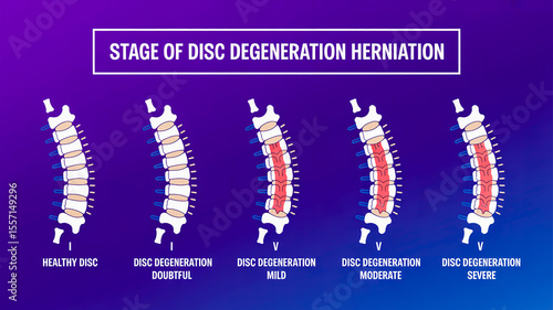A medical infographic showing the stages of disc degeneration and herniation across five vertebral segments