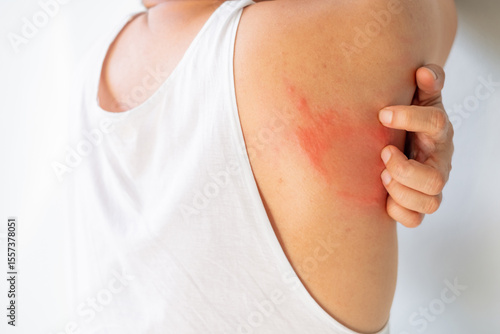 Foto Close up of a person scratching a red, inflamed rash on their armpit and back area