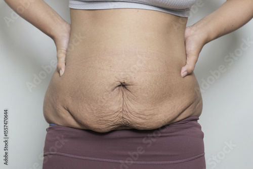 woman postpartum belly with stretch marks, problem after giving birth. promoting body positivity and the reality of motherhood