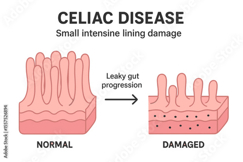 Celiac disease causes damage to the lining of the small intestine, affecting both healthy and damaged villi and leading to a leaky gut progression