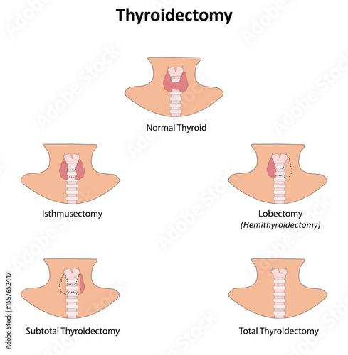 Thyroidectomy vector illustration