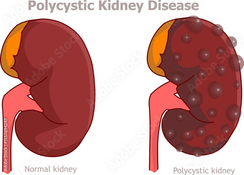 Polycystic kidney disease is a genetic disorder that causes many fluid filled cysts to grow in kidneys. Urinary system. Vector illustration