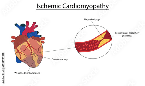 Ischemic cardiomyopathy vector illustration