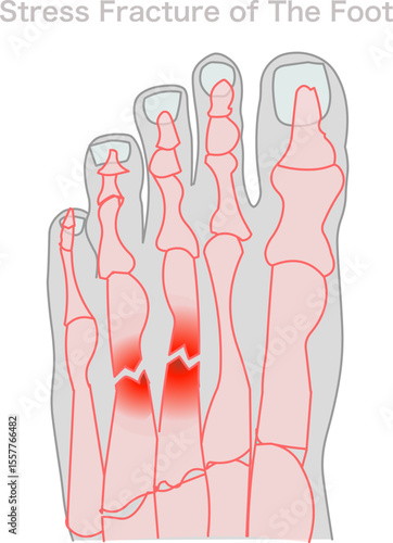 Stress fracture foot. X-ray, roentgen sample. Top foot x ray, big toe symptom structure. Orthopedic patients surgery anatomy.  Joint deformity feet bones. Illustration, medical vector