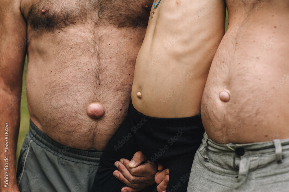 Naklejka premium Photograph, portrait of a family, three people with hereditary umbilical hernias. Concept of illness.