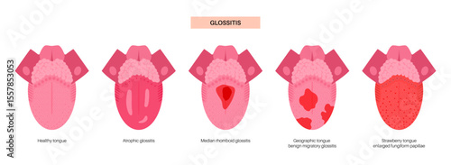 Tongue disease poster