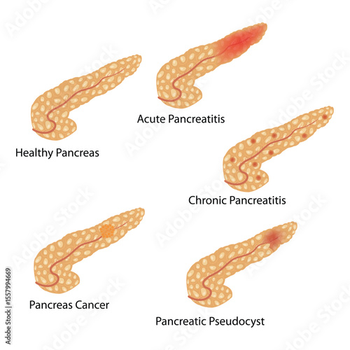 Medical Comparison Diagram of Pancreas Conditions: Healthy Pancreas, Acute and Chronic Pancreatitis, Pancreas Cancer, Pancreatic Pseudocyst.
