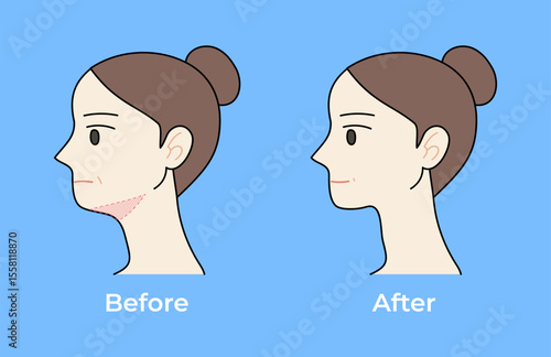 Face lifting before and after