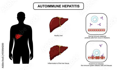 Autoimmune hepatitis disease. Liver organ with inflammation, infection and virus. Inflammation in human body. Vector illustration for medical, clinic or biology study