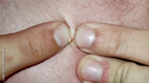 White pimple extraction. Cleaning skincare.