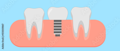 teeth and implant in the gum on a blue background,