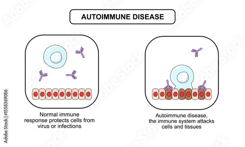 illustration of autoimmune and normal immune conditions in the human body, inflammation in the human body, vector illustration, cartoon illustration. design for medical poster needs or biology study

