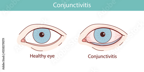 Conjunctivitis of the eye vector anatomical illustration