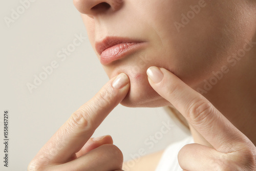 Obraz na plátne Young woman with a pimple on a chin
