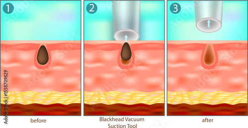 Blackhead Removal Process Using Vacuum Suction Tool - Before and After Skin Diagram. Illustration Showing Pore Cleansing with Vacuum Device in Three Stages