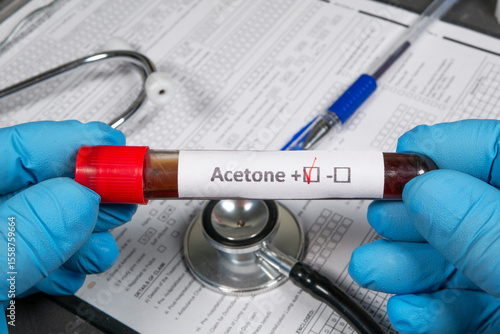 Doctor holding test tube with acetone positive result and stethoscope