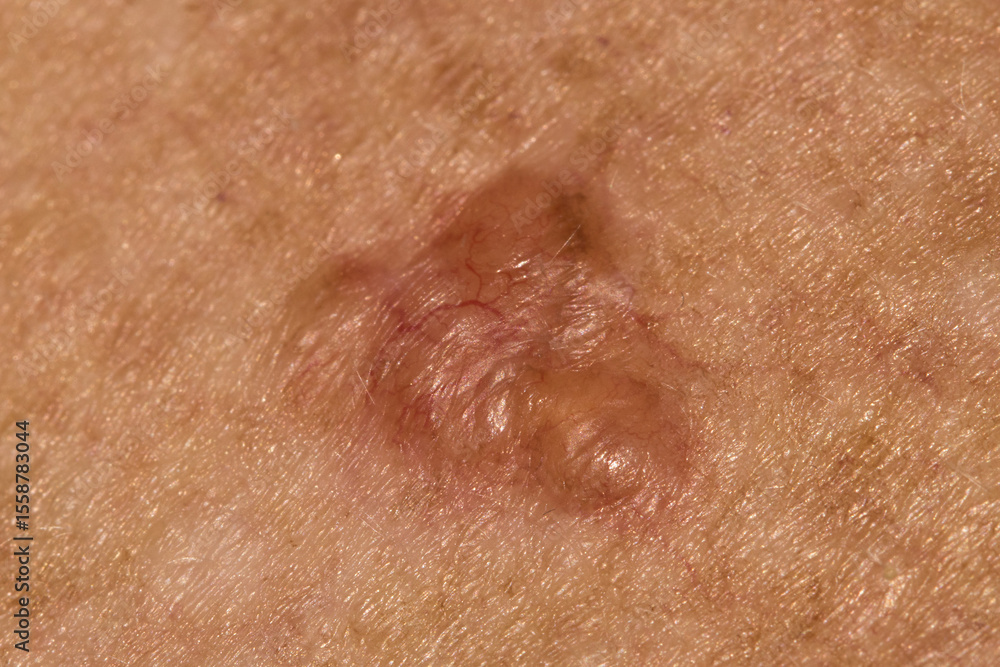 Fototapeta premium Basal cell carcinoma on the chest of a seventy year old Caucasian woman who has lived all her life in Africa