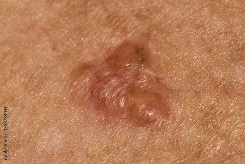 Basal cell carcinoma on the chest of a seventy year old Caucasian woman who has lived all her life in Africa