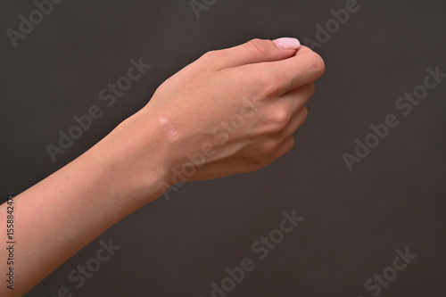 intricate scar details where ganglion cyst was excised. barely noticeable scar represents triumph over chronic wrist pain after successful surgery to remove a benign tumor - hygroma.