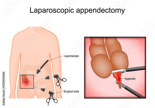 Laparoscopic surgery. Appendectomy