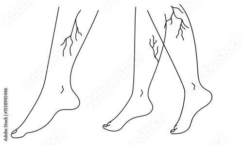 Drawing of  woman's legs with vein diseases. Varicose veins and thrombophlebitis. Linear  vector illustration.