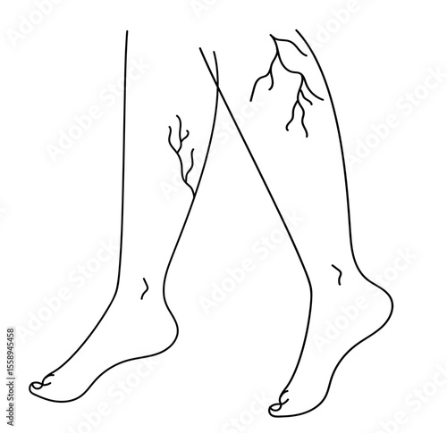 Drawing of  woman's legs with vein diseases. Varicose veins and thrombophlebitis. Linear  vector illustration.