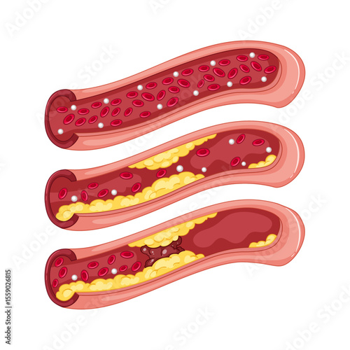 Artery Health in Focus: A medical illustration meticulously details the progression of artery health, from pristine condition to advanced blockage, emphasizing the importance of proactive wellness.