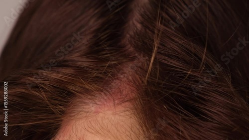 Skin disease of the head, psoriasis, large dandruff in the hair, redness, peeling