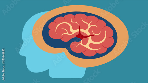 An enlarged CT scan revealing enlarged ventricles in the brain a sign of hydrocephalus and potential cause of cognitive impairment.. Vector illustration