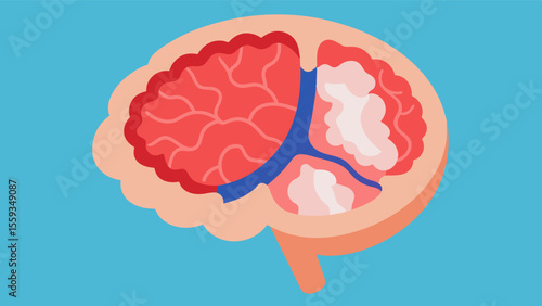 Crosssection of a brain affected by stroke displaying a blocked or ruptured vessel and its resulting damage to brain tissue.. Vector illustration