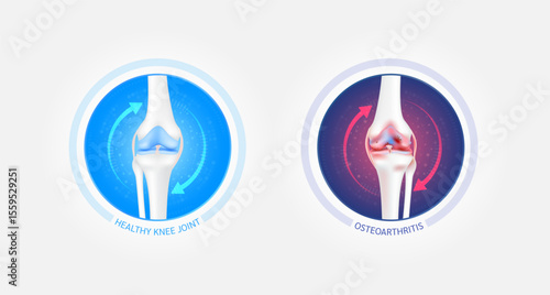 Healthy bone and osteoarthritis or osteoporosis with red blue arrows spin around. Knee joint leg cartilage becomes worn. Comparative images of normal and inflammation bones. Vector EPS10.