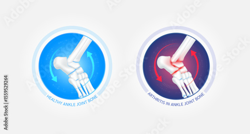 Healthy ankle bone and arthritis or osteoporosis with red blue arrows spin around. Joint cartilage becomes worn. Comparative images of normal and inflammation bones. Vector EPS10.