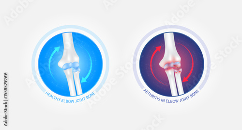 Healthy elbow bone and arthritis or osteoporosis with red blue arrows spin around. Joint cartilage becomes worn. Comparative images of normal and inflammation bones. Vector EPS10.