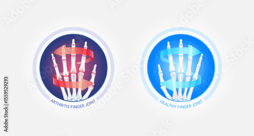 Healthy finger joint and arthritis or osteoporosis with red blue arrows spin around. Hand cartilage bone becomes worn. Comparative images of normal and inflammation bones. Vector EPS10.