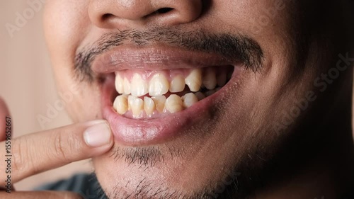 Close up of Southeast Asian man smiling and showing his uneven and yellow teeth 