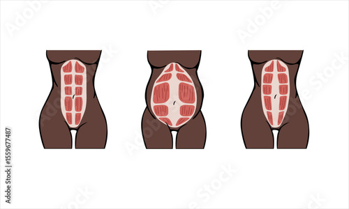 Different types of Diastasis. Dark-skinned woman. Diastasis in a woman before, during and after pregnancy. The anatomy of a Woman. A woman's muscular corset before and after childbirth. 
