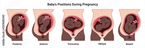 Different baby positions in the uterus during pregnancy. Dark-skinned woman. Anterior, Posterior, Cephalic, Breech, Transverse, Oblique positions. Pathology. Detailed medical vector illustration. 
