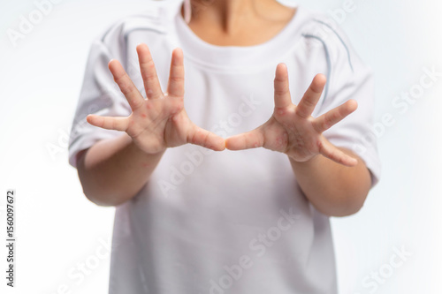 Hand, foot and mouth disease HFMD Human hand of scarlet fever in coxsackievirus palmarosa virus and child hand on white background