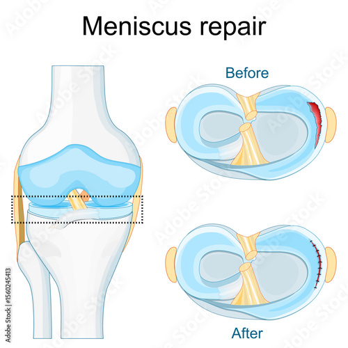 Meniscus injury and healing. Close-up of knee joint.