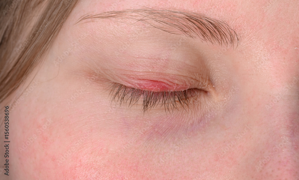 Obraz premium Inflammation on the eyelid, stye on the eye