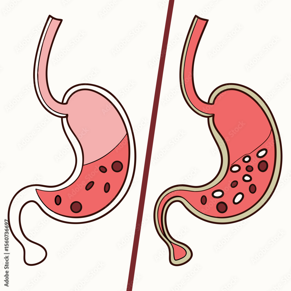 Fototapeta premium Human stomach. Healthy and unhealthy, Bloating stomach ache, digestive tract pain fullness heaviness stomaches acid heartburn process