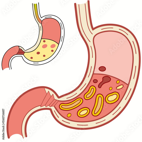 Human stomach. Healthy and unhealthy, Bloating stomach ache, digestive tract pain fullness heaviness stomaches acid heartburn process