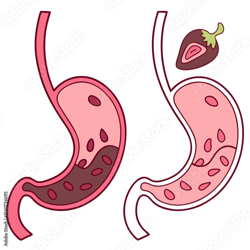 Human stomach. Healthy and unhealthy, Bloating stomach ache, digestive tract pain fullness heaviness stomaches acid heartburn process