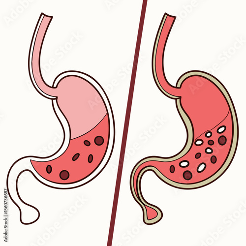 Human stomach. Healthy and unhealthy, Bloating stomach ache, digestive tract pain fullness heaviness stomaches acid heartburn process