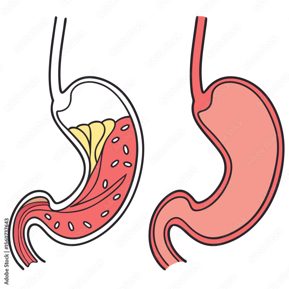 Fototapeta premium Human stomach. Healthy and unhealthy, Bloating stomach ache, digestive tract pain fullness heaviness stomaches acid heartburn process